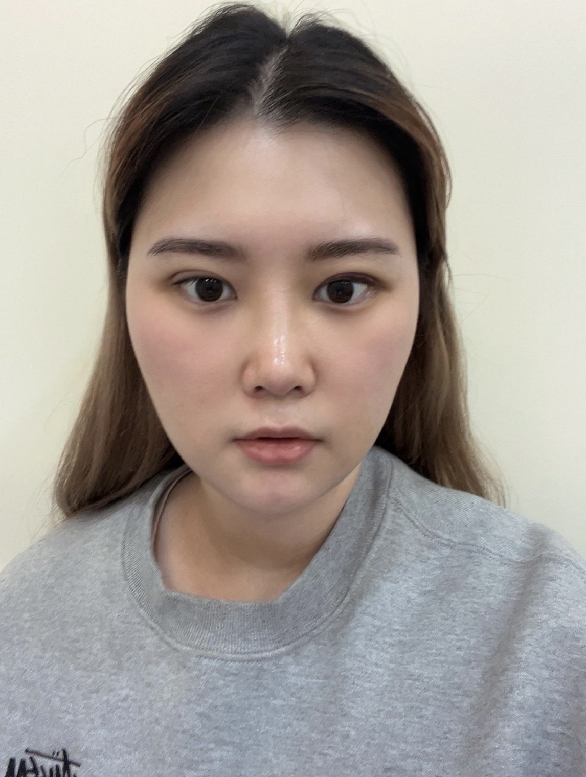 수술후기이미지