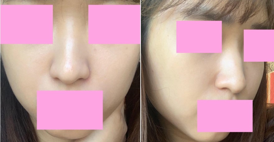 수술후기이미지