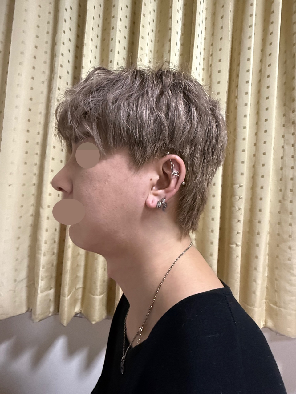 수술후기이미지