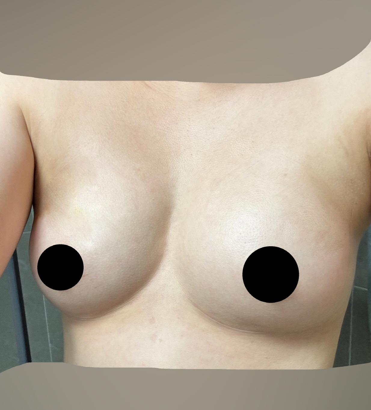 수술후기이미지