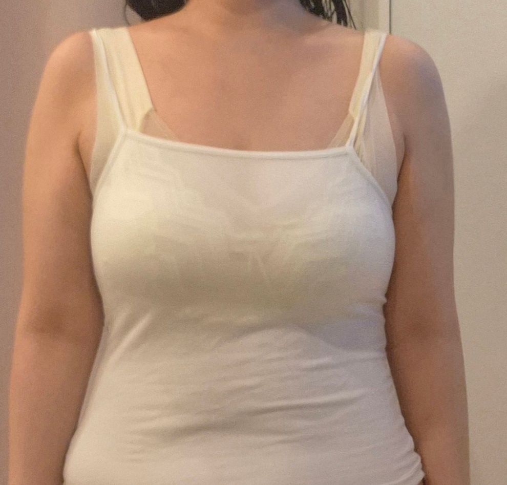 수술후기이미지