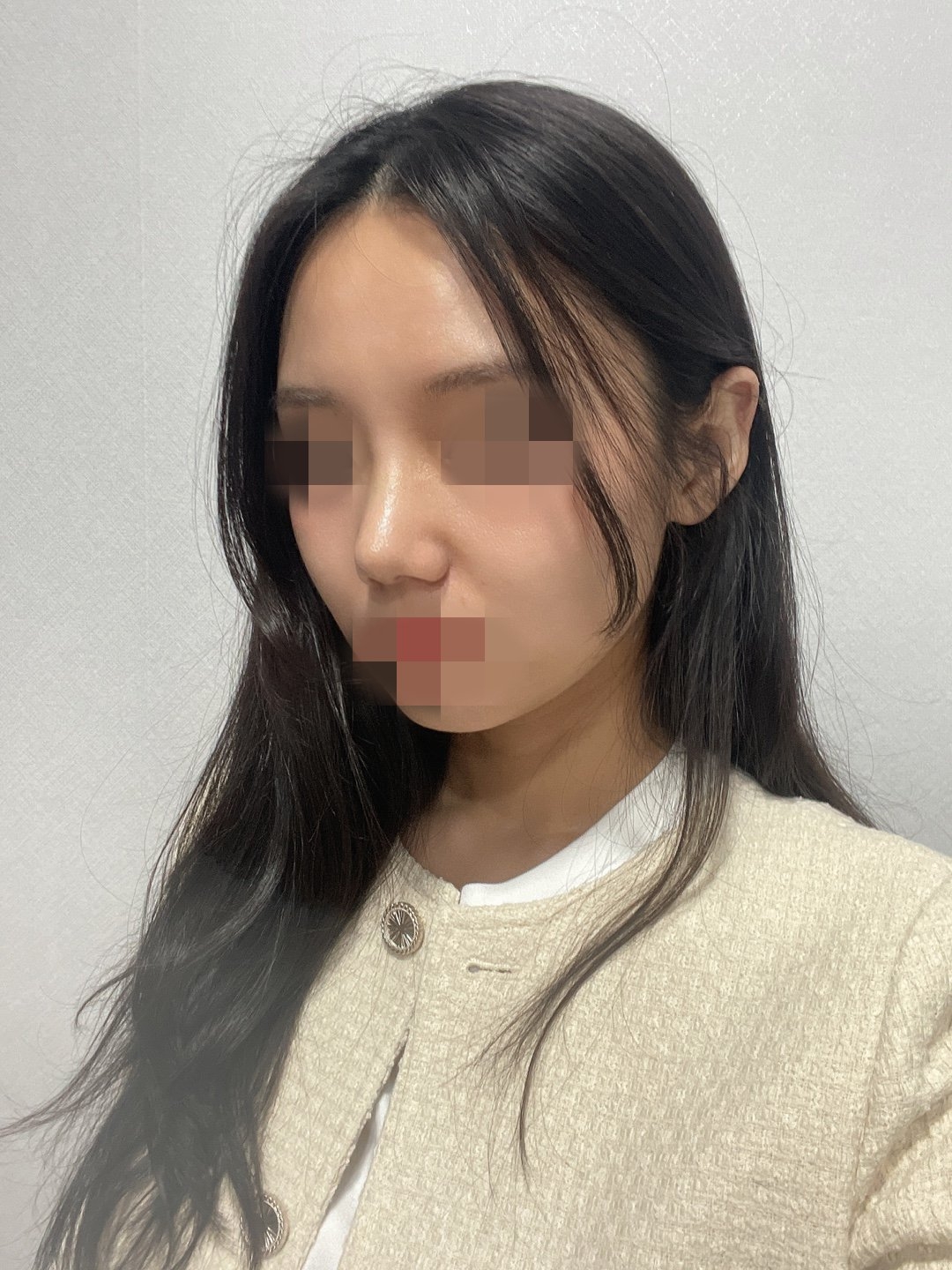 수술후기이미지