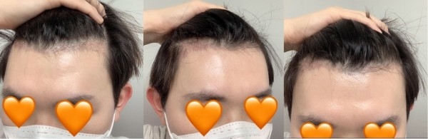 모발이식 두달차 후기