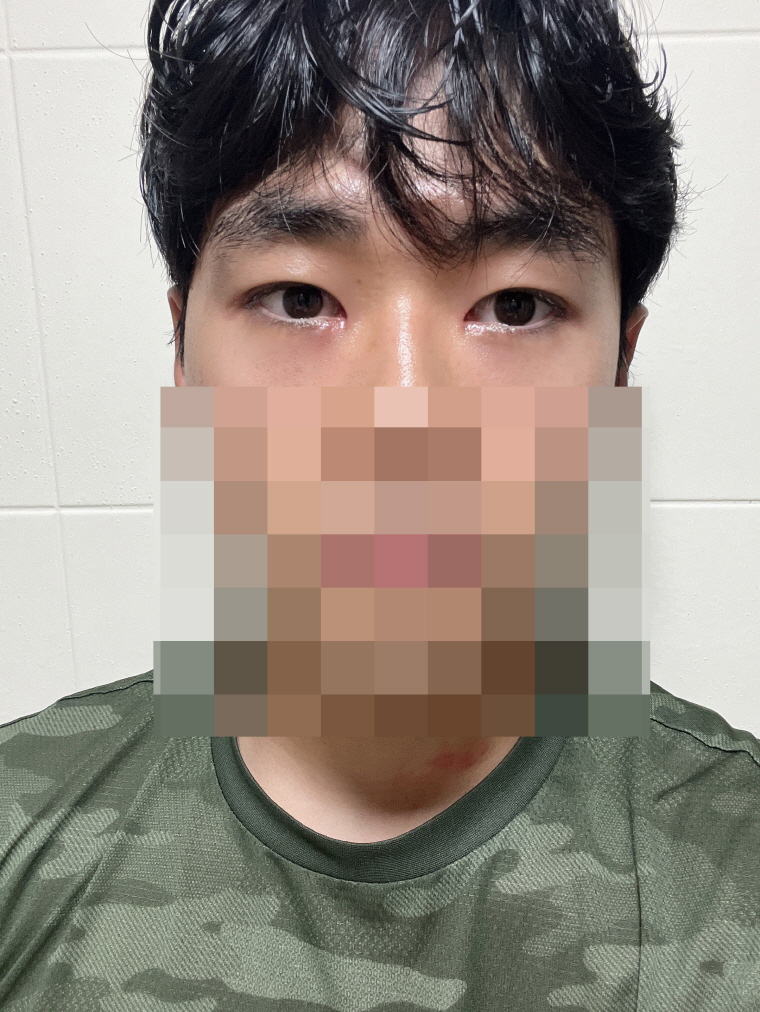 수술후기이미지