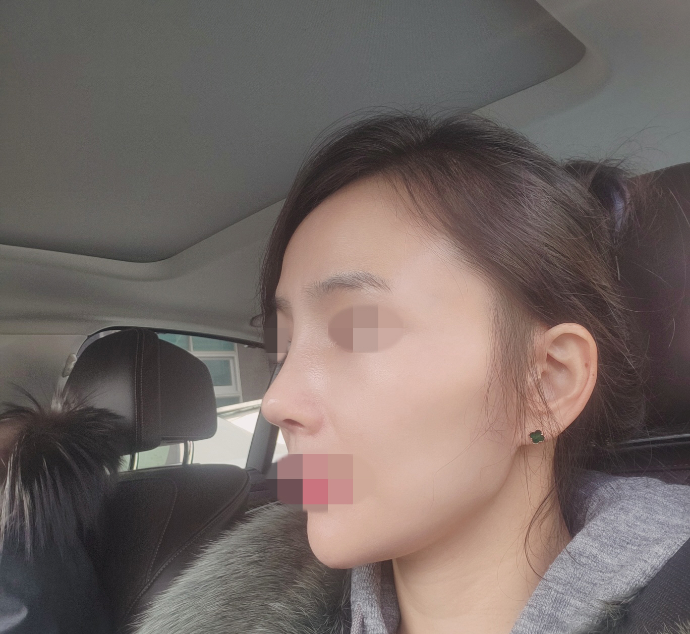 수술후기이미지