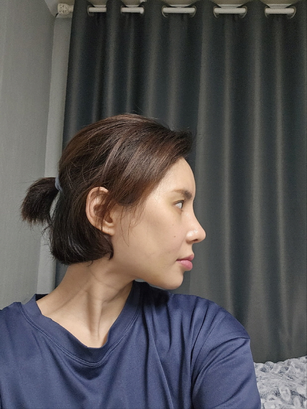 수술후기이미지