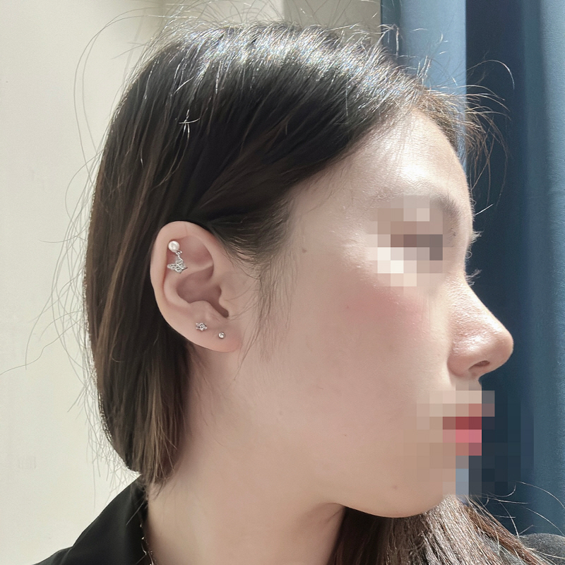 수술후기이미지