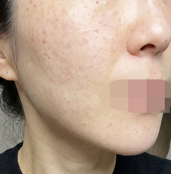 수술후기이미지