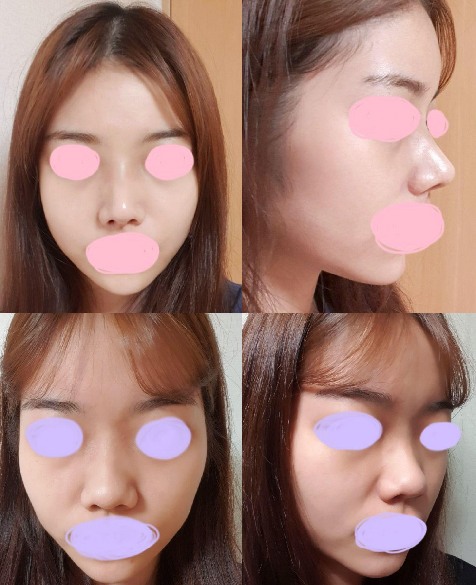 수술후기이미지