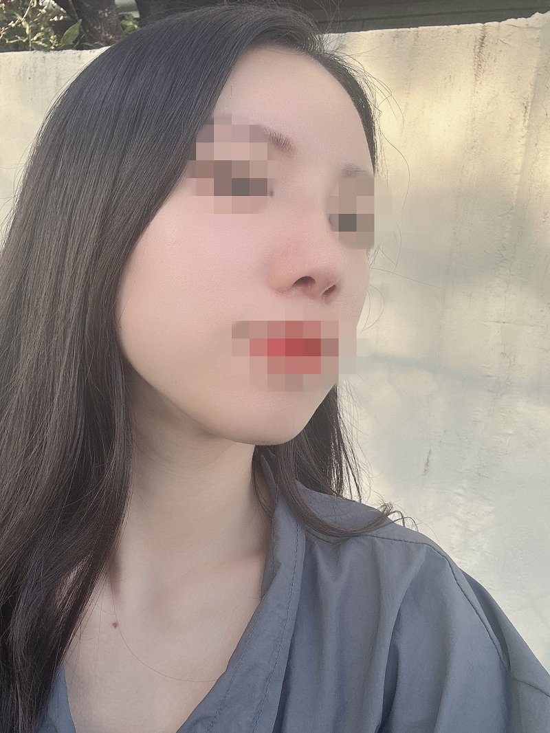 수술후기이미지