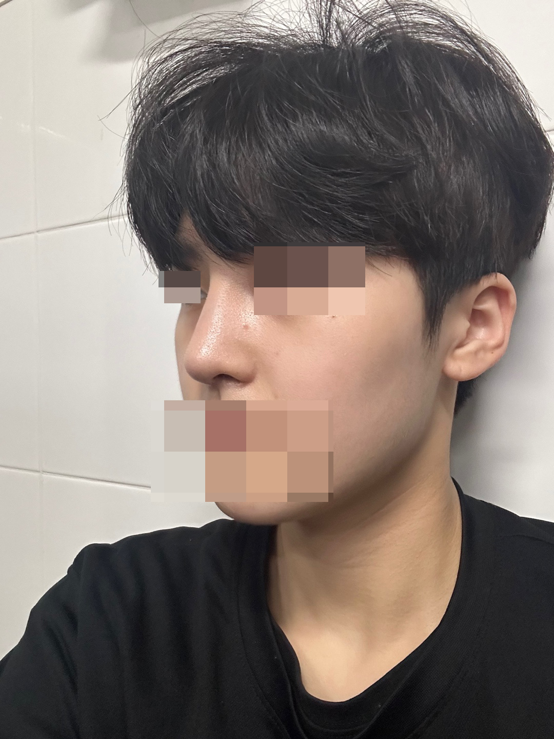 수술후기이미지