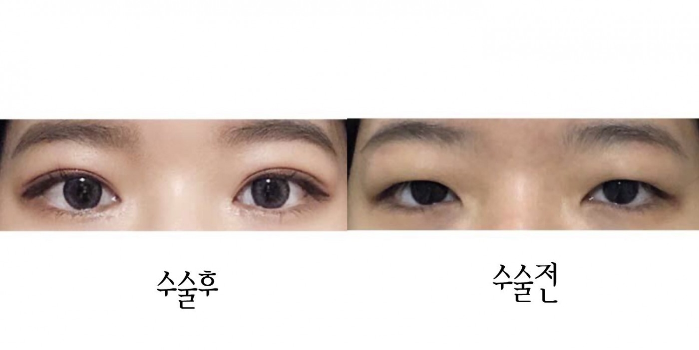 수술후기이미지