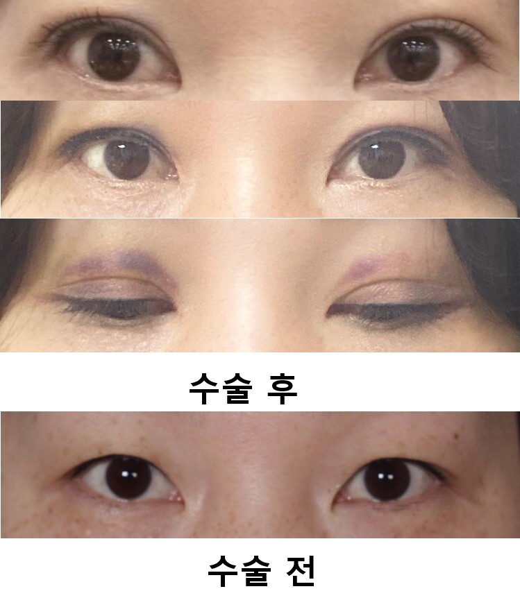 수술후기이미지