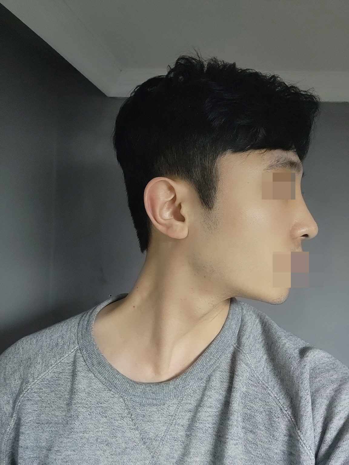 수술후기이미지