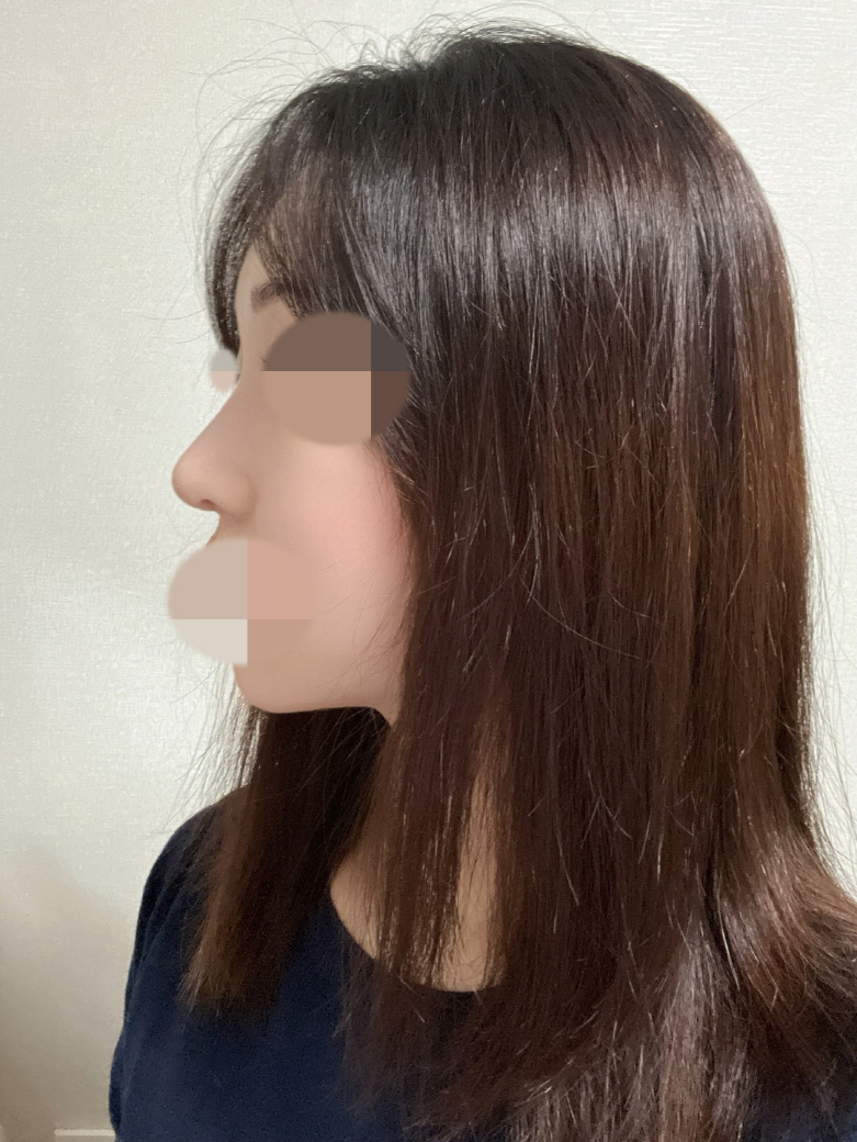 수술후기이미지