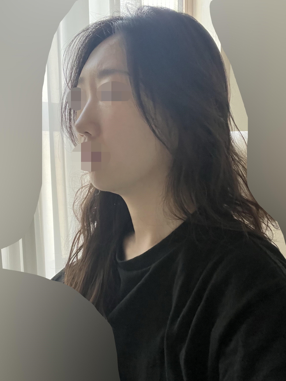 수술후기이미지