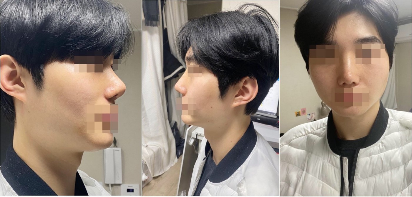 수술후기이미지