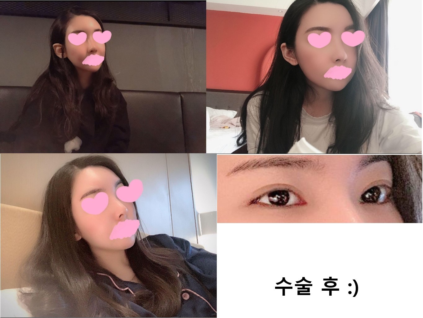 수술후기이미지