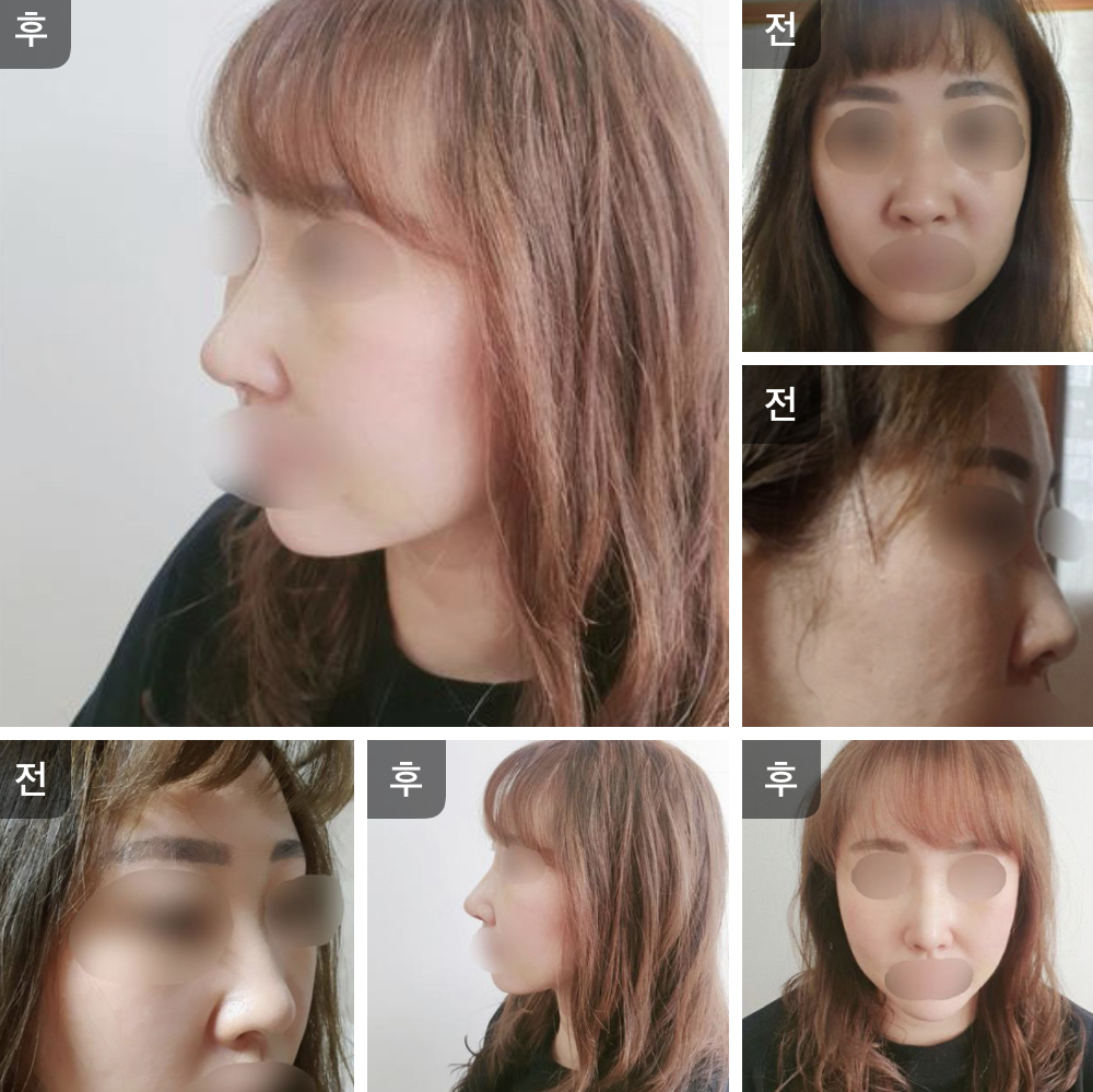 수술후기이미지