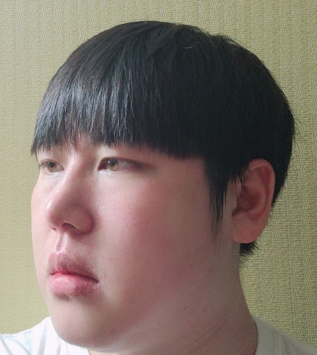 수술후기이미지