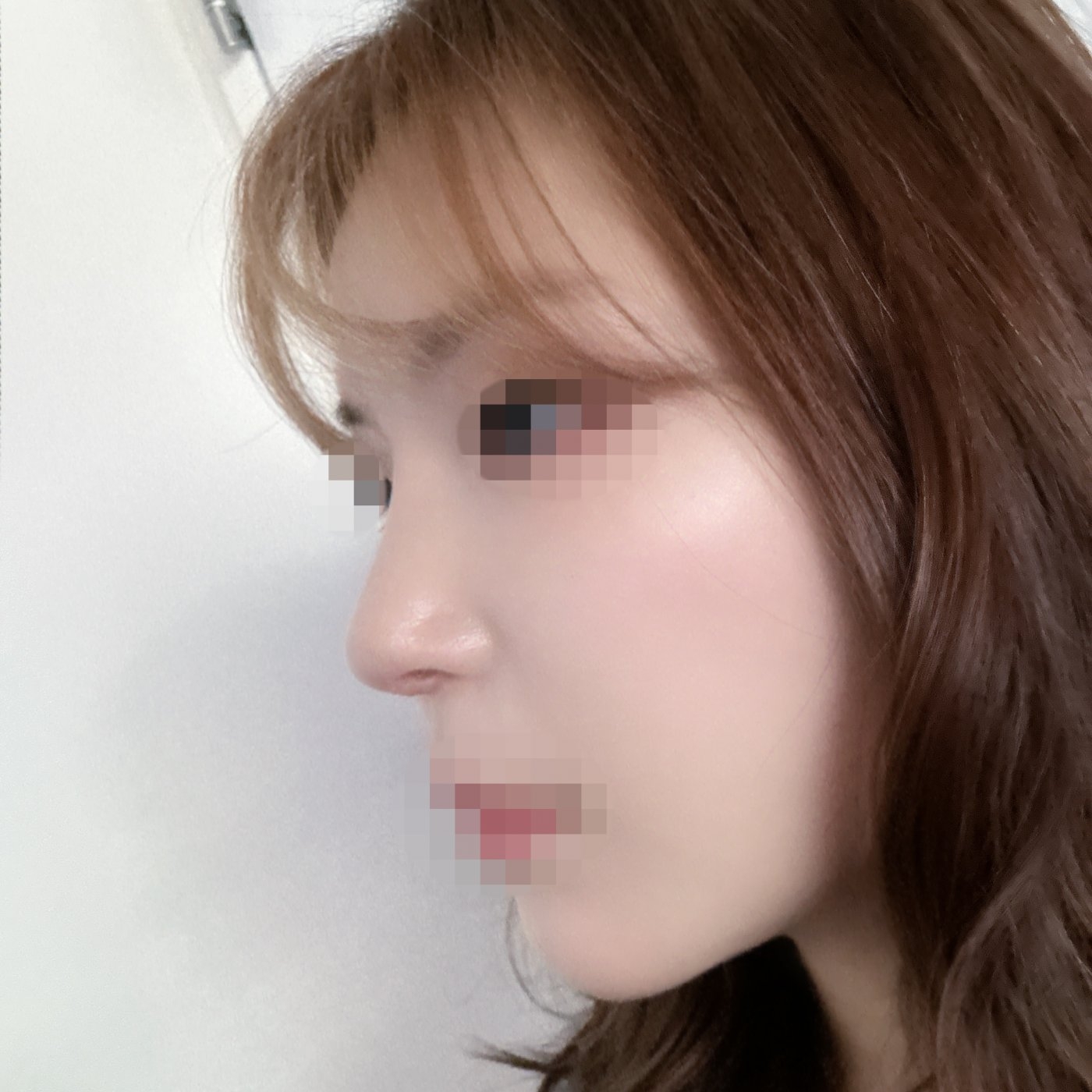 수술후기이미지