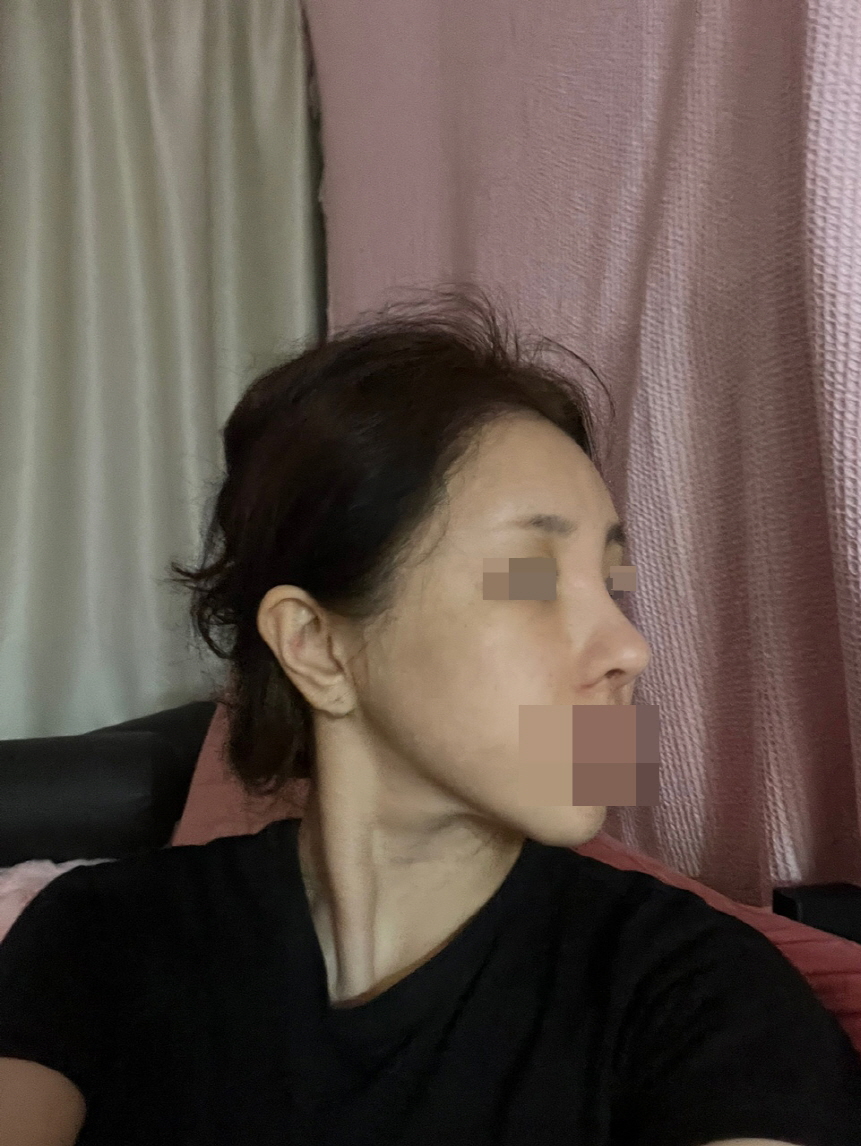 수술후기이미지