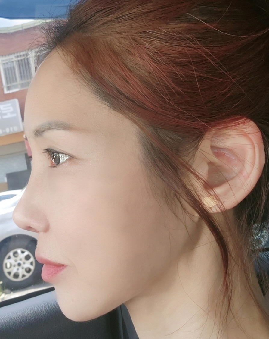 수술후기이미지