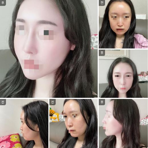 수술후기이미지