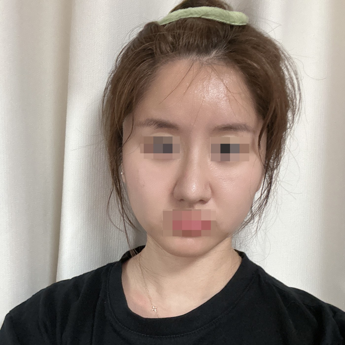 수술후기이미지