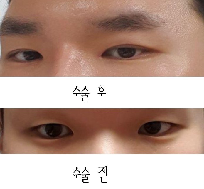 자연유착+앞트임