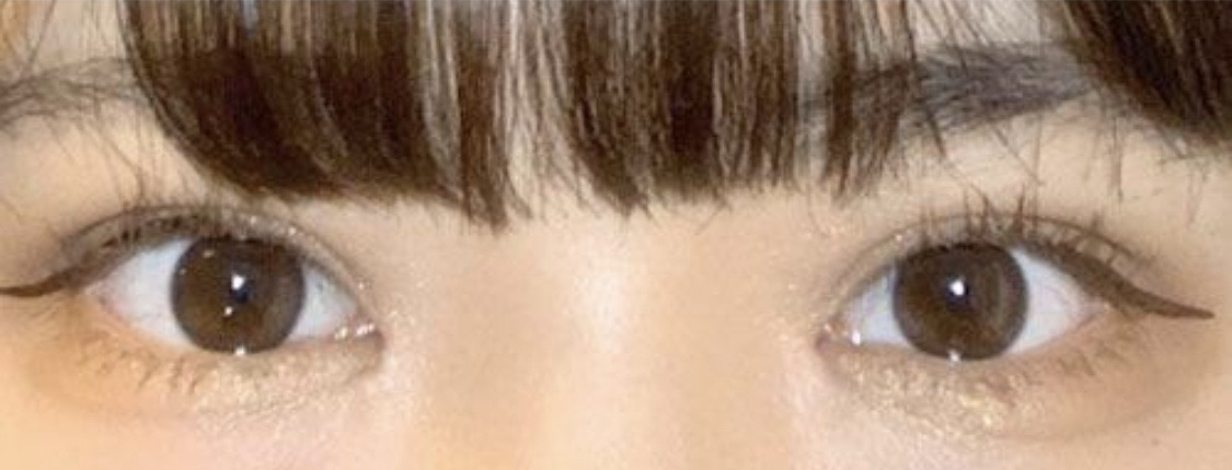 수술후기이미지