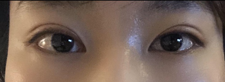 수술후기이미지