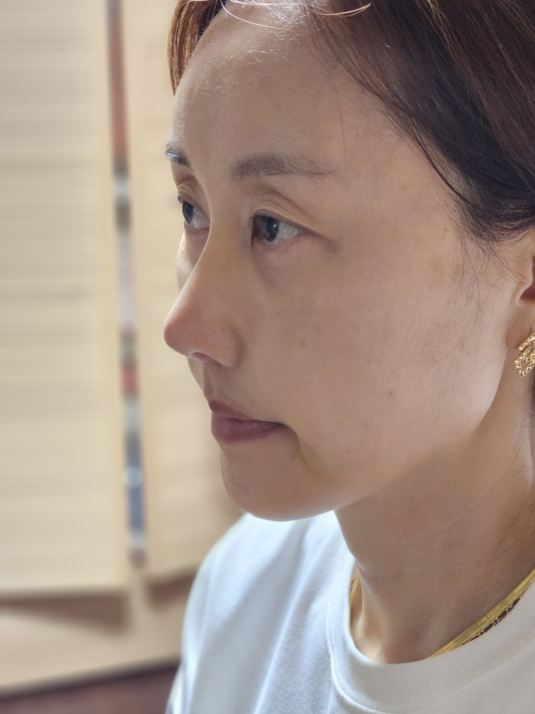 수술후기이미지