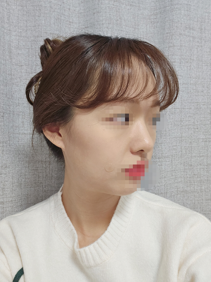 수술후기이미지