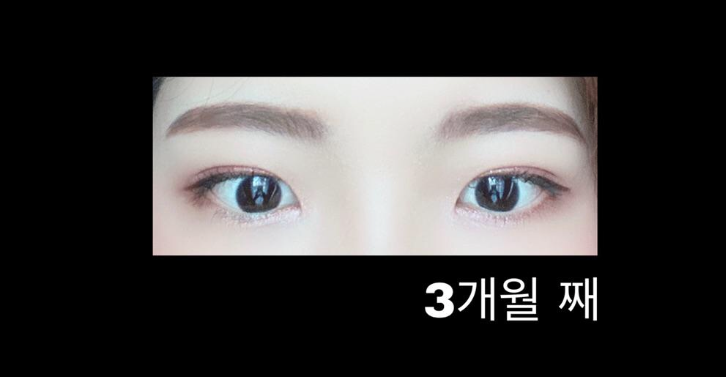 수술후기이미지