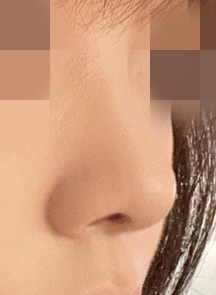 수술후기이미지