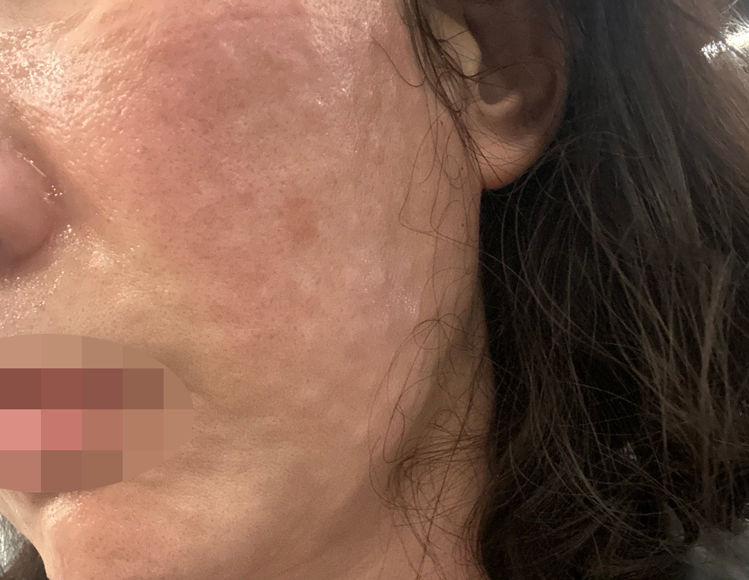 수술후기이미지