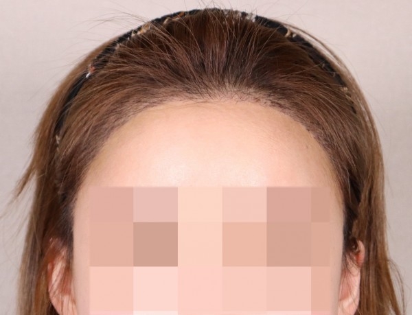 리쥬란힐러 알아보다가 모발이식한 썰이야...ㅋㅋㅋ