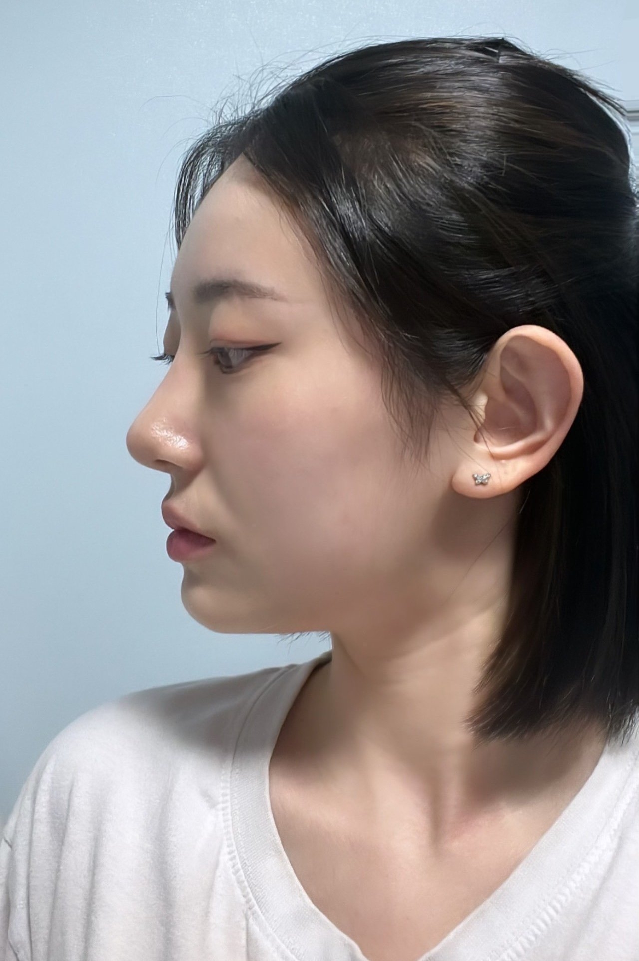 수술후기이미지