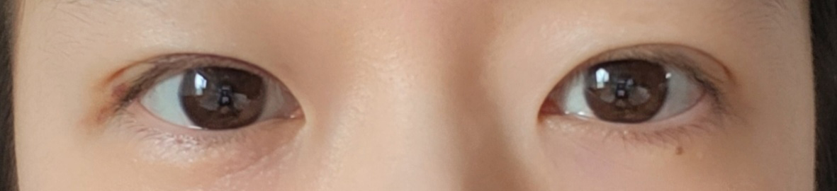 수술후기이미지