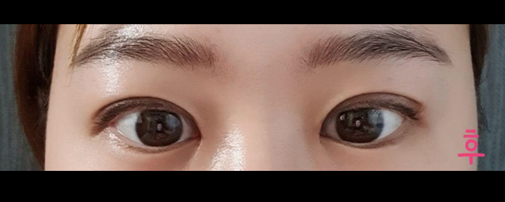 수술후기이미지