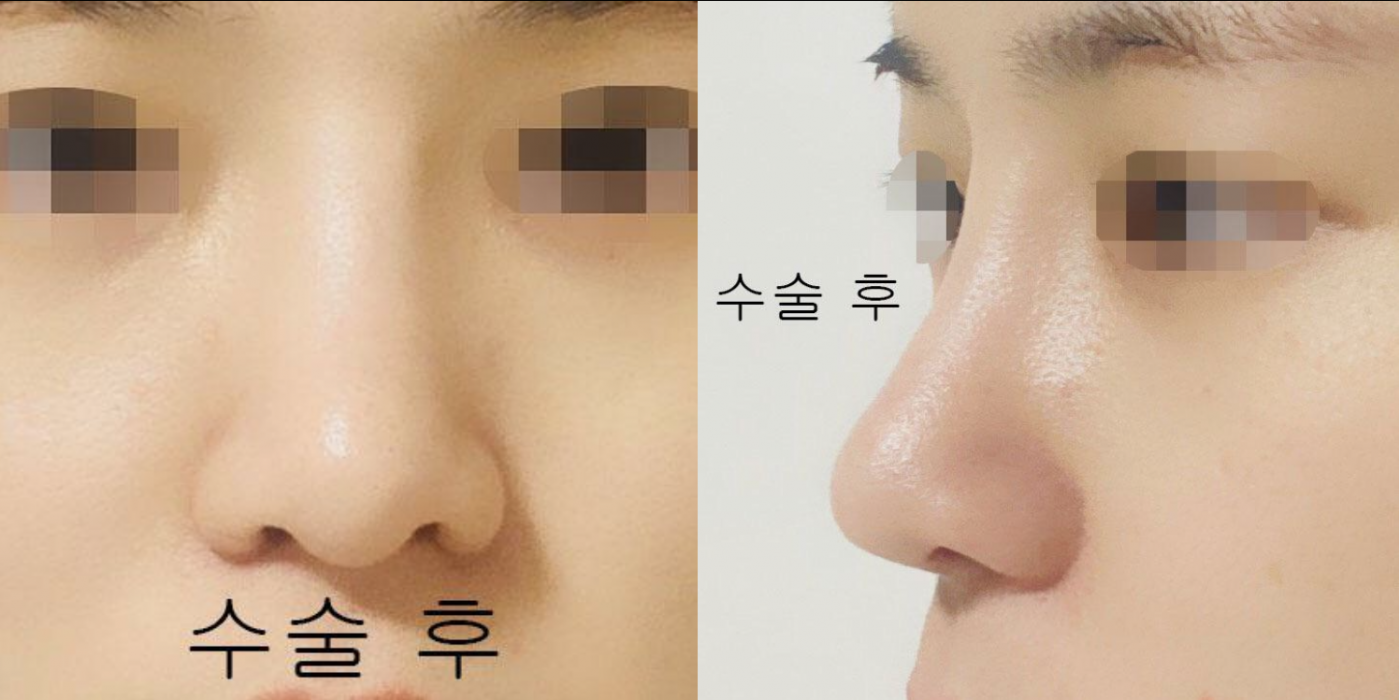 수술후기이미지