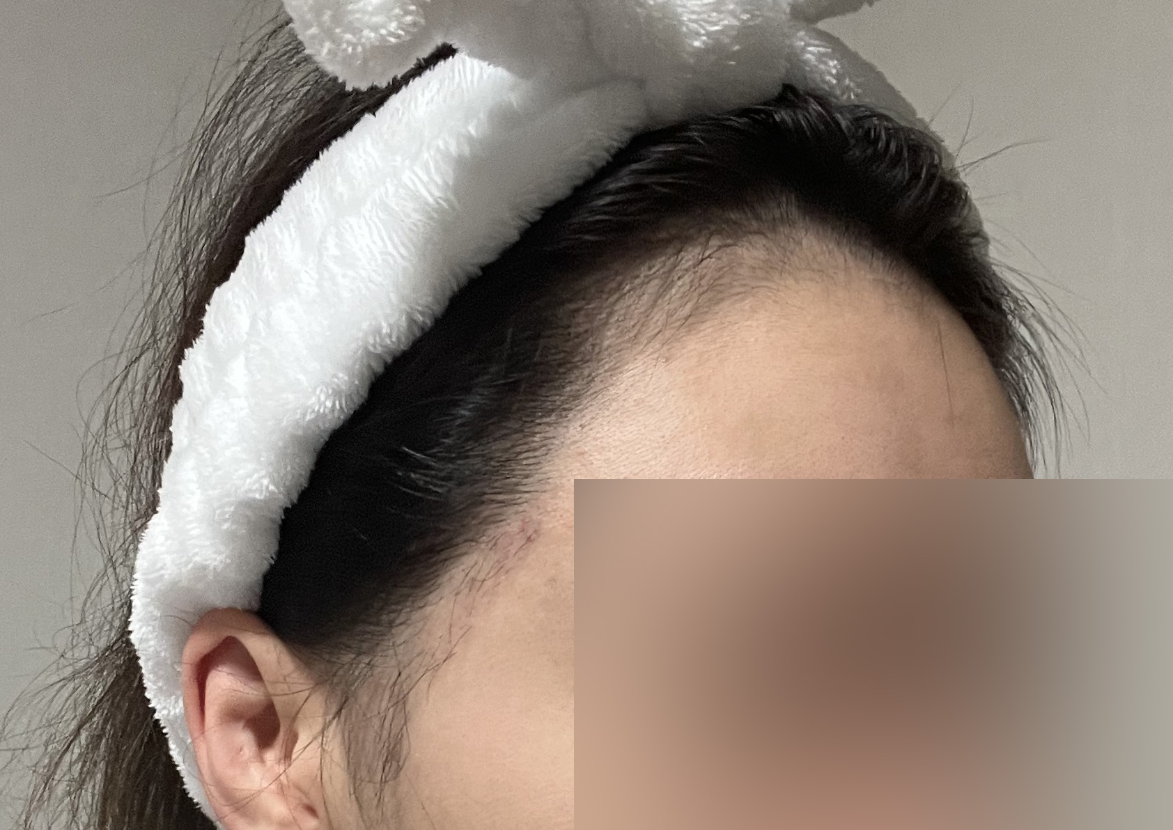 수술후기이미지