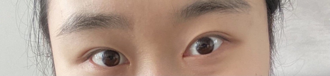 수술후기이미지