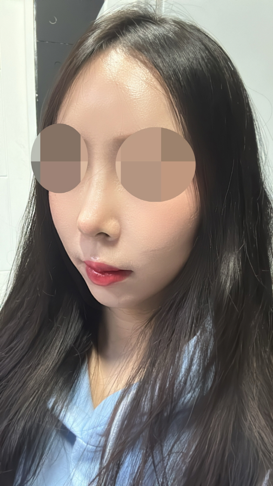 수술후기이미지