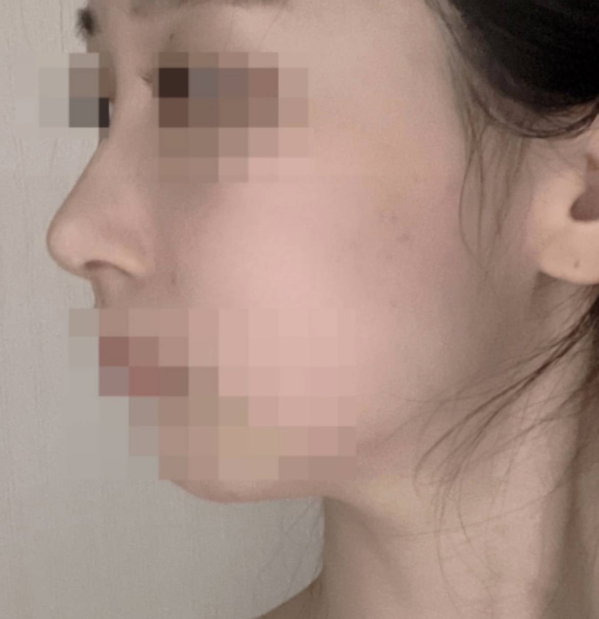 수술후기이미지