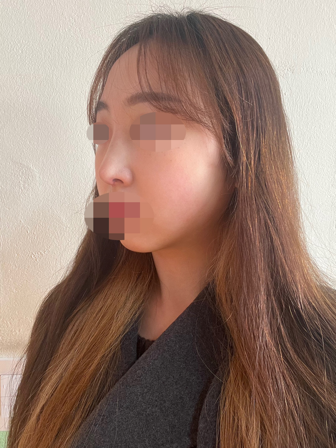 수술후기이미지