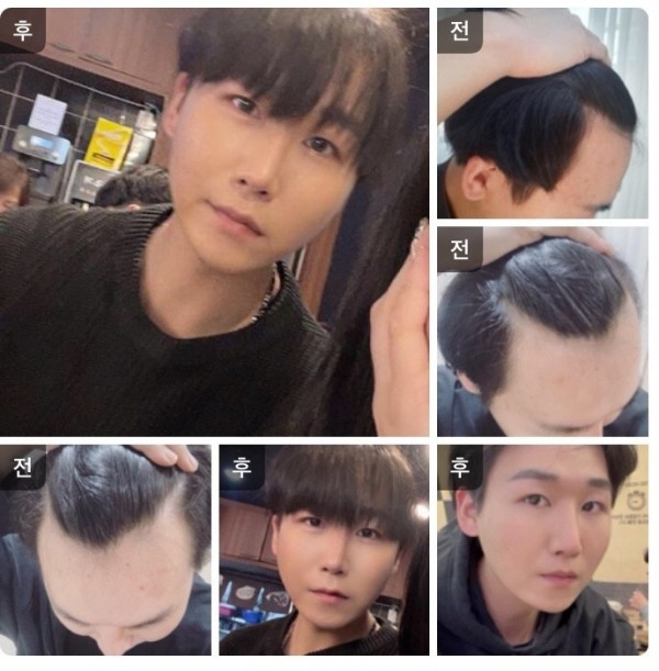 모발이식 리프팅 시술