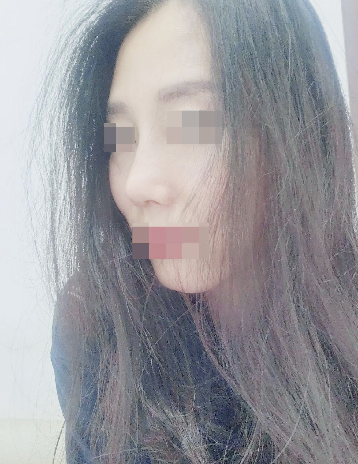 수술후기이미지