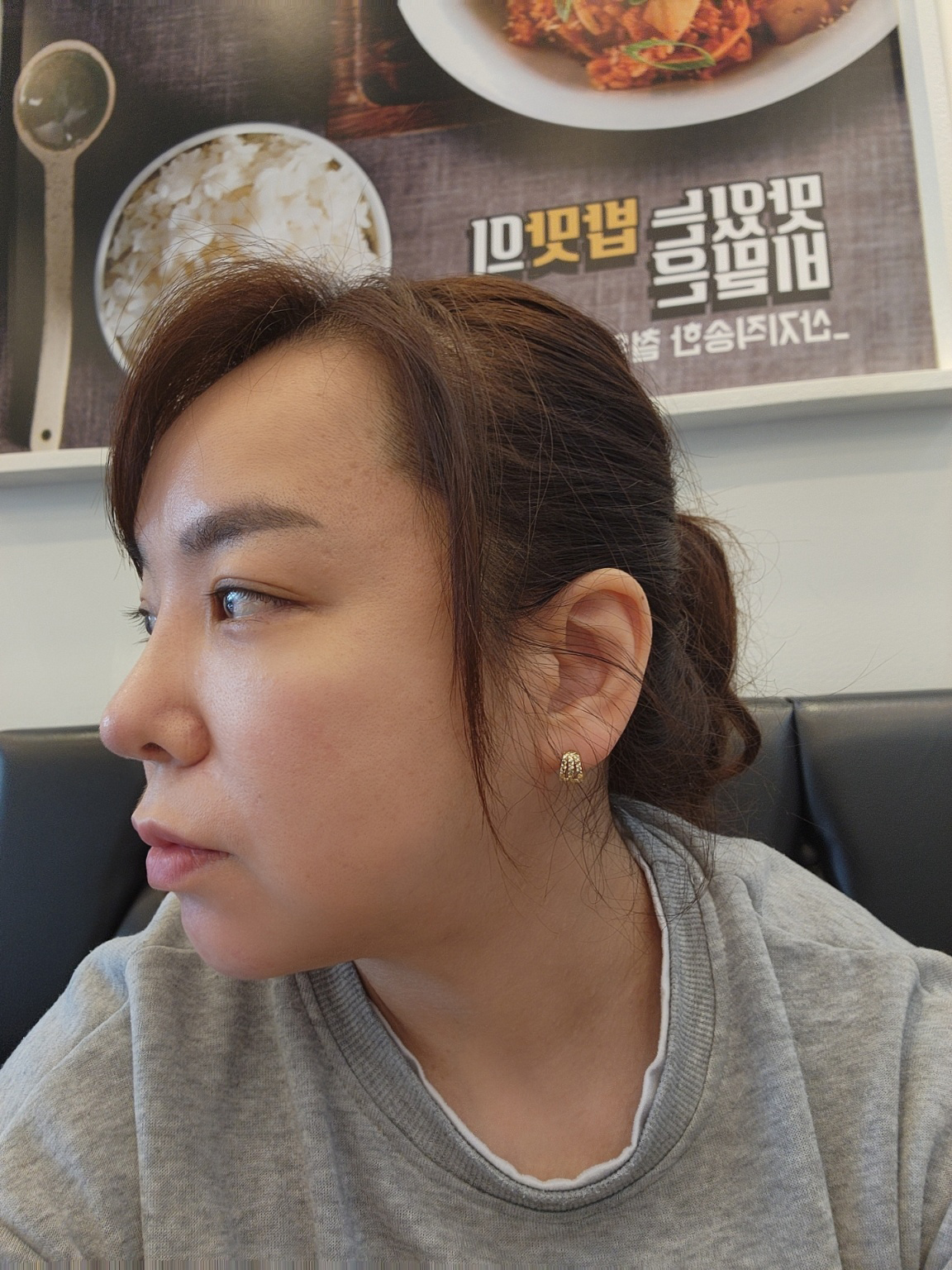 수술후기이미지